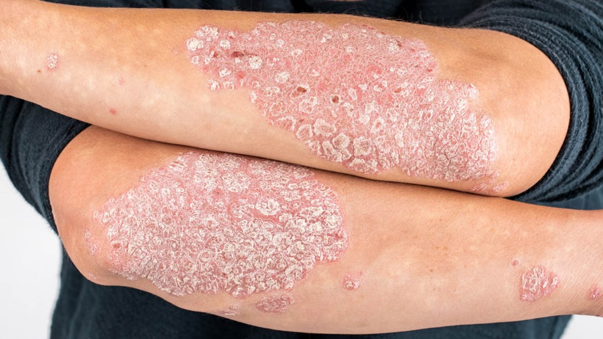 ayurvedic-treatment-for-psoriasis