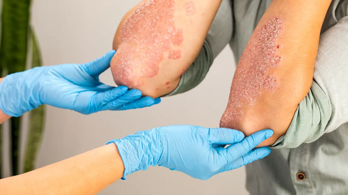 best ayurvedic treatment for psoriasis in kerala